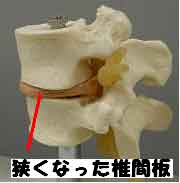 狭くなった椎間板