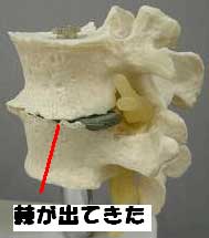 骨棘から変形性頚椎症へ