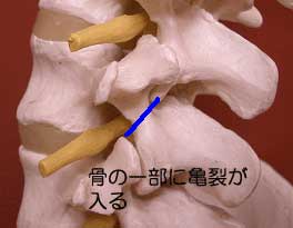 脊椎分離症の分離箇所