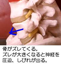 分離すべり症による神経圧迫