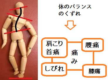 股関節痛とカイロプラクティック